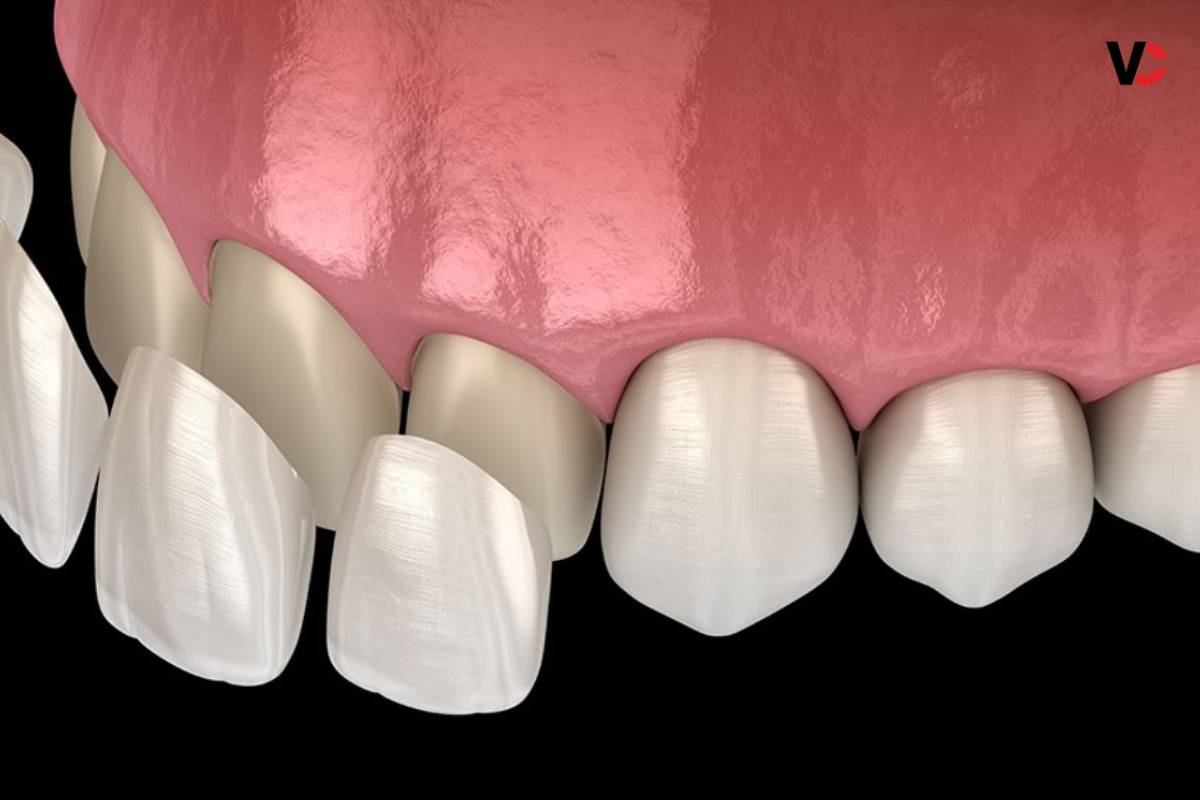 Exploring the Pros and Cons of Veneers: A Comprehensive Guide