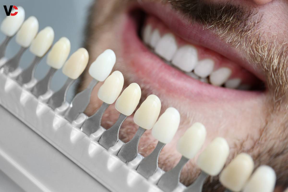 5 Important Benefits of Veneers | Visionary CIOs