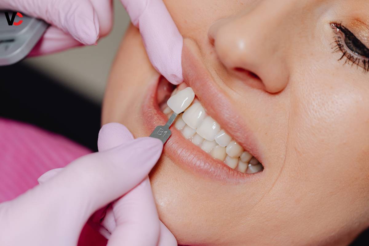 5 Important Benefits of Veneers | Visionary CIOs