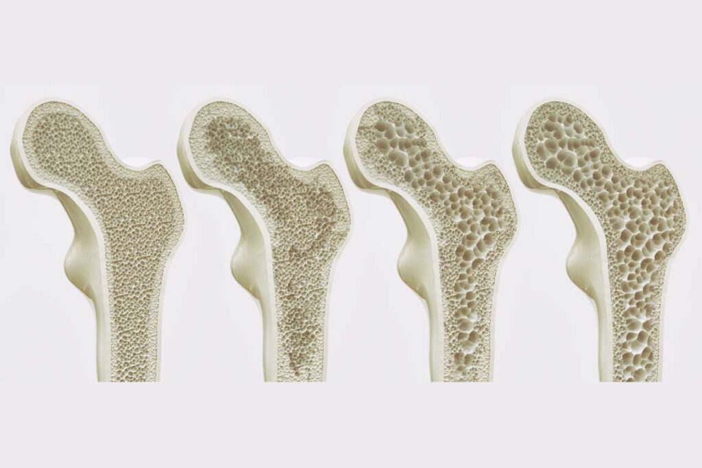 Top 4 Stages of Osteoporosis | Visionary CIOs